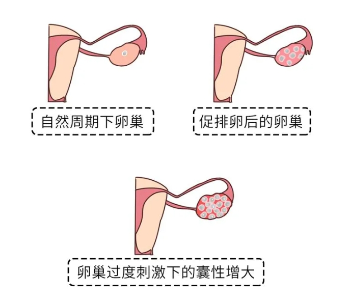 试管婴儿治疗中为何使用阿司匹林？阿司匹林在试管婴儿治疗中其具体作用是什么？