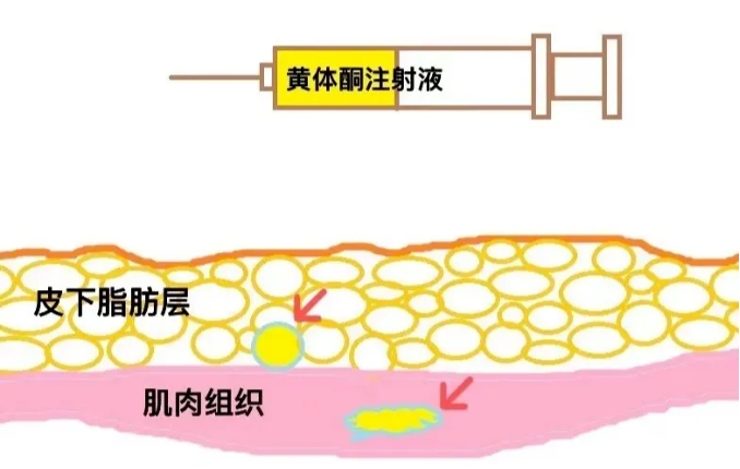 为什么试管婴儿治疗中需要进行黄体酮注射？打黄体酮针后出现局部硬结怎么办？