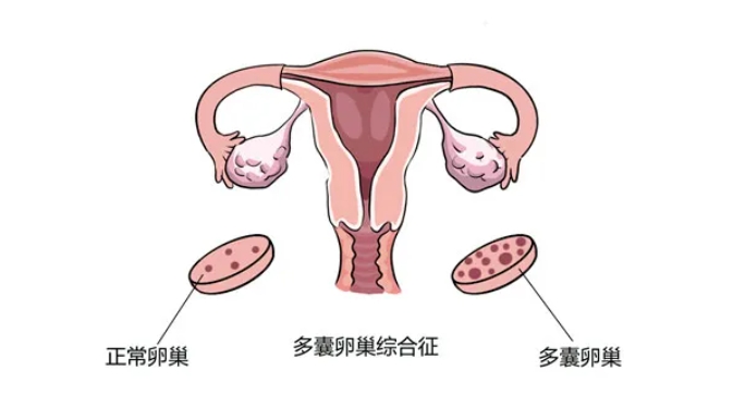 试管婴儿移植前为什么需要进行降调？哪些人群需要在试管婴儿移植前打降调针？