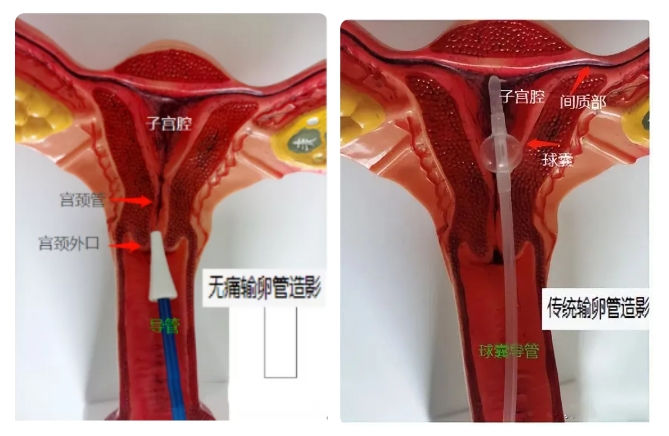 试管婴儿成功率受哪些因素影响？输卵管积水在其中扮演了什么角色？