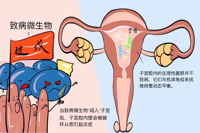 什么是慢性子宫内膜炎？慢性子宫内膜炎如何影响试管婴儿成功率？