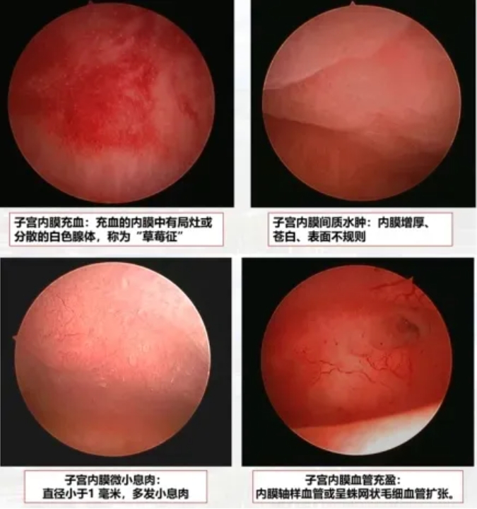 什么是慢性子宫内膜炎？慢性子宫内膜炎如何影响试管婴儿成功率？