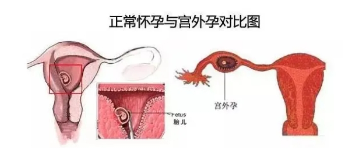 试管婴儿过程中宫外孕的风险如何？如何通过试管婴儿技术降低宫外孕的可能性？