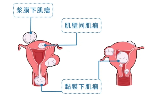 什么是子宫肌瘤？子宫肌瘤是怎么发生的？不孕子宫肌瘤患者先做试管婴儿还是手术?