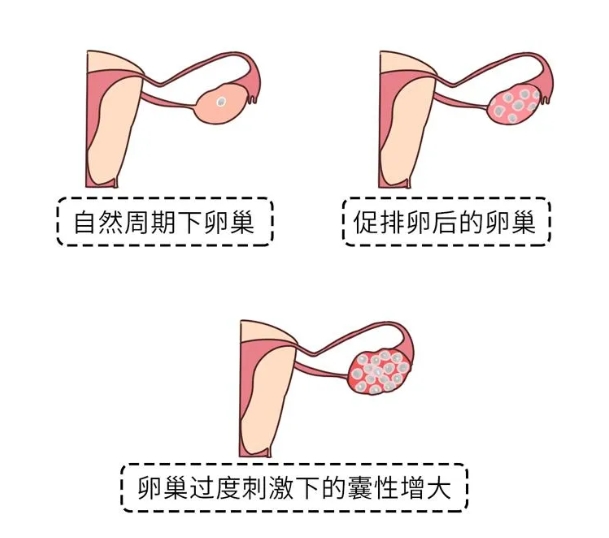 试管婴儿促排卵期间患者需要注意哪些事项？试管促排期间五大注意事项助力好孕