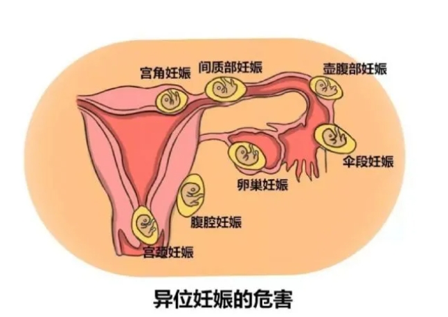 试管婴儿移植后验孕棒显示“两道杠”就真的怀孕了吗？如何解读早孕期超声报告结果判断是否成功怀孕？