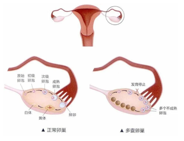 试管婴儿能帮助多囊卵巢综合征患者成功怀孕吗？多囊卵巢综合征患者怀孕后如何有效保胎？