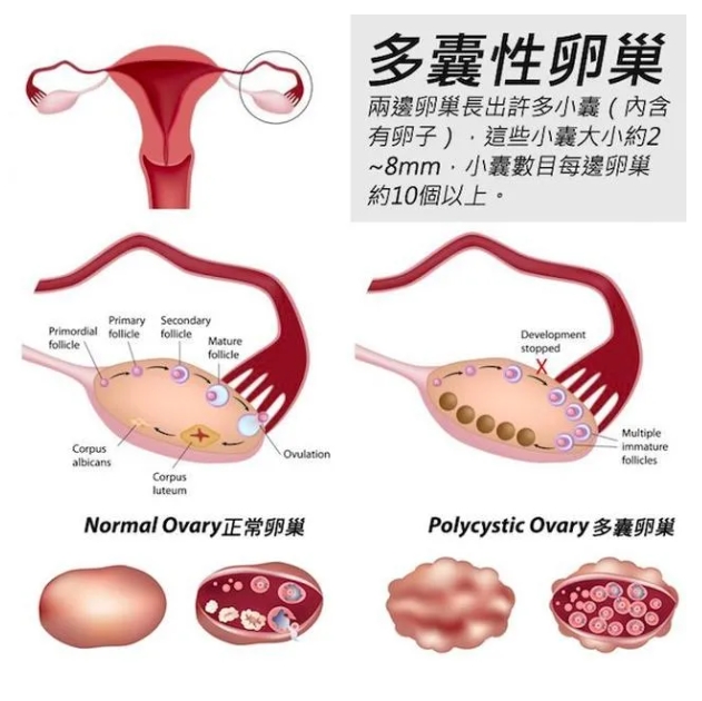 什么是胰岛素抵抗？如何通过改善胰岛素抵抗来提高试管婴儿成功率？