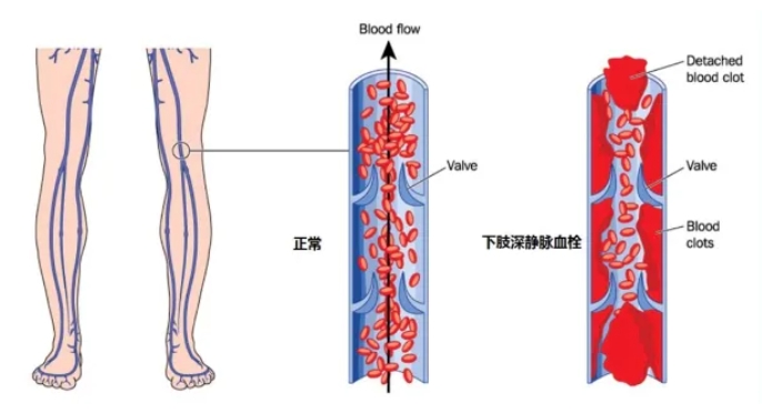 试管婴儿的过程中影响子宫内膜容受性的因素有哪些？如何提高子宫内膜容受性？