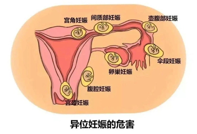 试管婴儿孕早期HCG翻倍不佳的原因有哪些？如何应对试管婴儿孕早期HCG翻倍不佳的问题？