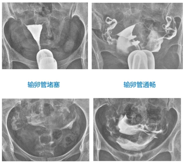 做输卵管造影疼不疼？试管都要做输卵管造影吗？做输卵管造影前后注意事项有哪些?