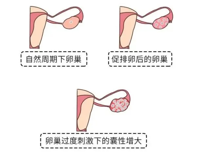 试管婴儿取卵数量多少与哪些因素有关？做试管婴儿取多少个卵子合适？试管婴儿促排卵真的是数量越多越好吗？