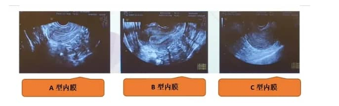 试管婴儿过程中子宫内膜容受性为何至关重要？如何通过超声检查评估试管婴儿子宫内膜容受性？