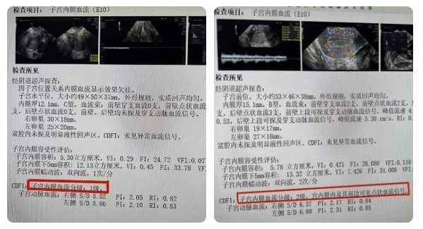 什么是子宫动脉血流？试管婴儿失败与子宫动脉血流有何关联？影响子宫内膜血流的因素及改善方法是什么？