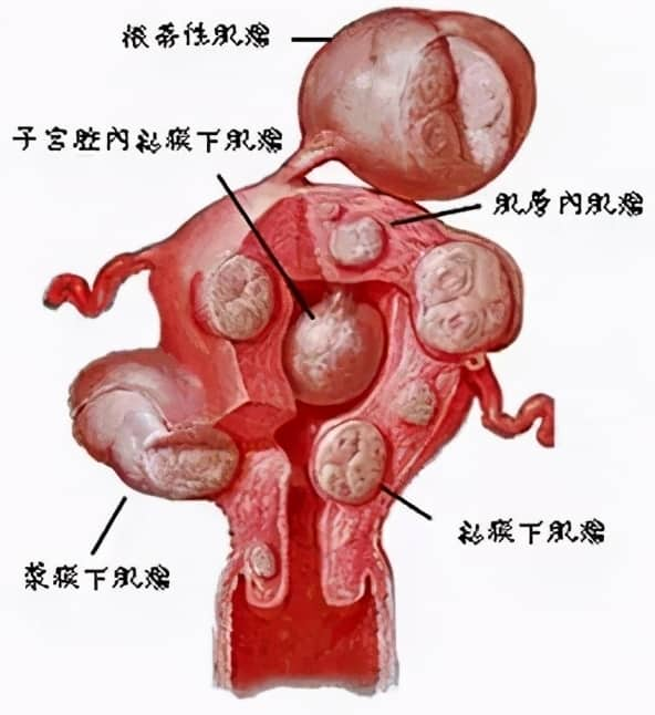 有子宫肌瘤还可以正常生育吗？试管婴儿治疗中子宫肌瘤的影响有哪些？子宫肌瘤术后多久可以再怀孕？