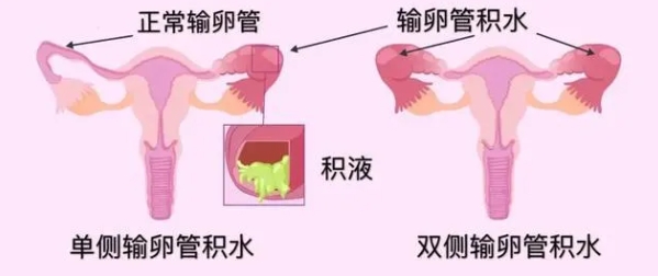 做试管婴儿前发现输卵管积水该如何处理？输卵管积水对试管婴儿成功率有何影响？