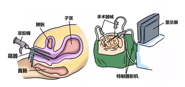 做试管婴儿前一定要做宫腔镜检查吗？宫腔镜检查对试管婴儿助孕有什么帮助？