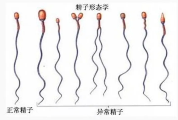 精子形态学异常会影响试管婴儿的结果吗？试管婴儿过程中精子畸形率高应该怎么办？