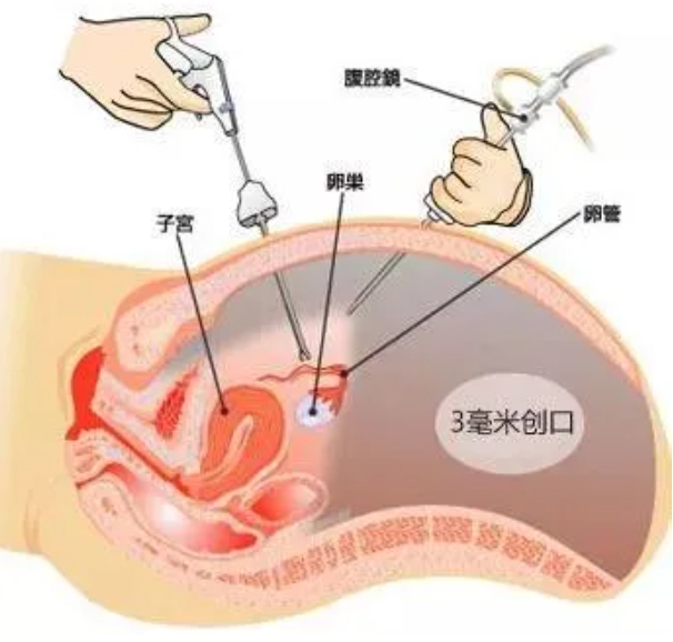 输卵管积水是什么？输卵管积水对生育力的影响有哪些？输卵管积水的处理方式是什么？