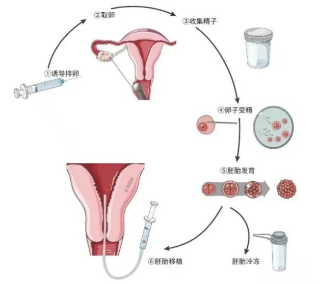 试管婴儿技术真的是一代比一代强吗？三代试管婴儿为什么不能直接做呢？