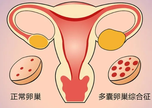 多囊卵巢综合征的诊断标准是什么？多囊卵巢综合征患者如何提高怀孕几率？