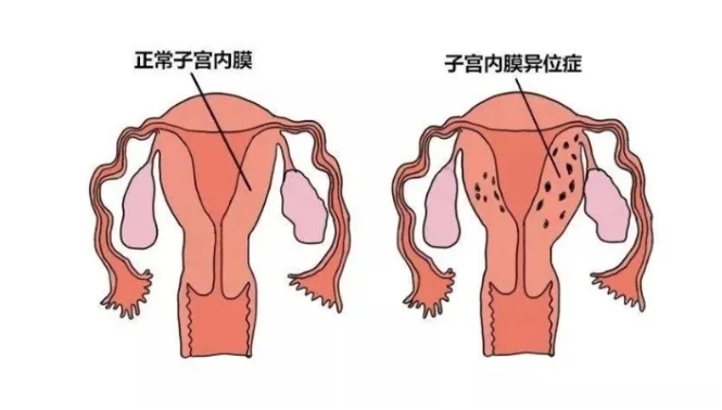 什么是子宫内膜异？子宫内膜异位症是如何影响试管婴儿成功率的一个因素？