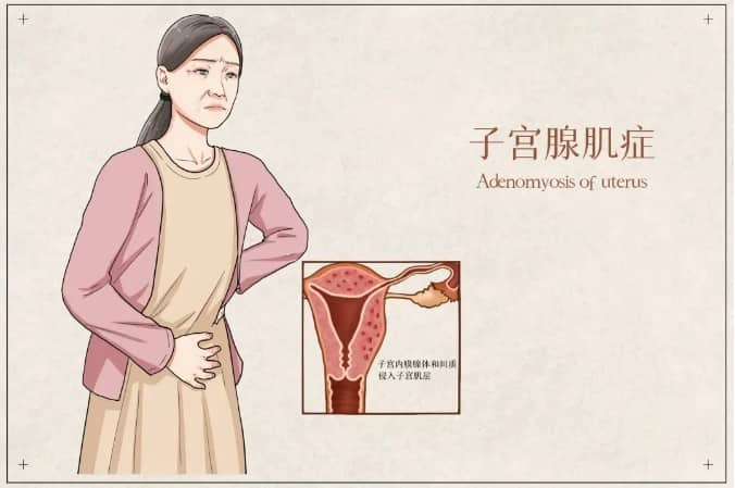 子宫肌腺病是怎么回事？子宫肌腺病对生育力的影响有哪些？如何缓解腺肌症？