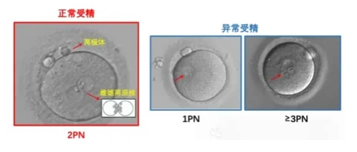 试管婴儿如何看懂胚胎报告？为什么试管婴儿解冻后的胚胎还会掉等级？