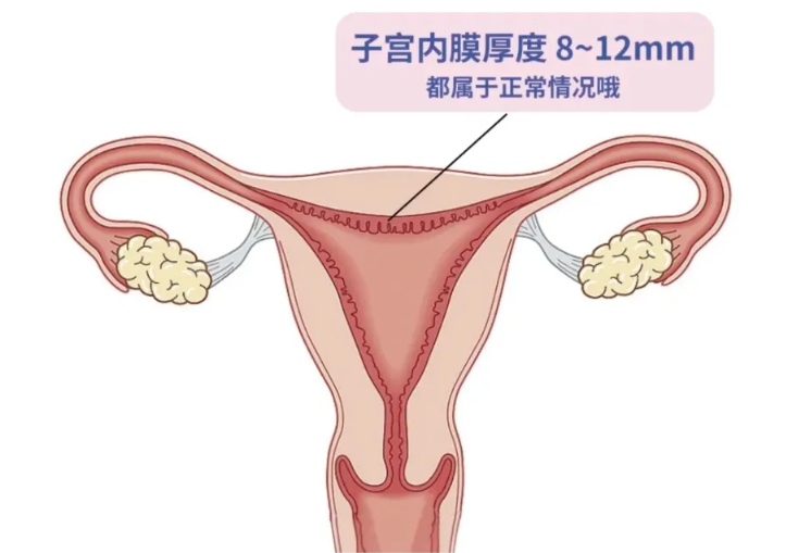 子宫内膜厚度为何对怀孕如此关键？哪些因素会影响到子宫内膜的厚度？