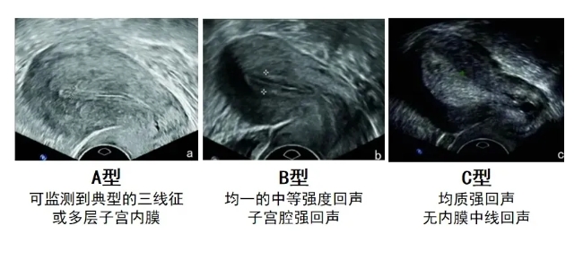 什么样的子宫内膜更容易怀孕？试管婴儿移植前如何调整子宫内膜状态？