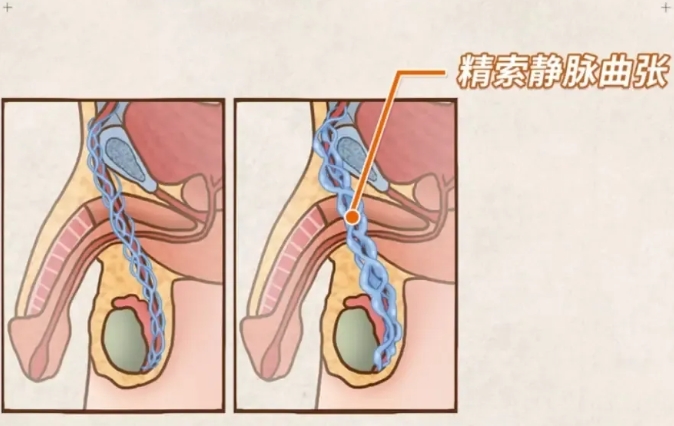 弱精少精症的主要原因是什么？弱精少精症怎么才能有效的的预防和治疗？