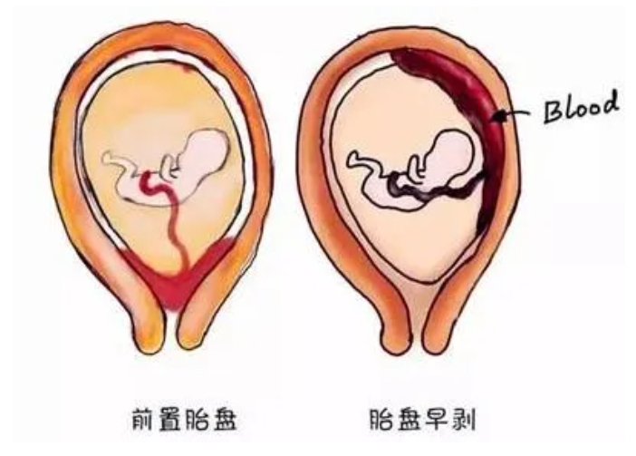 ​患有多囊的女性后代更容易患上心血管疾病吗？多囊卵巢综合征如何影响儿童的健康和发育？