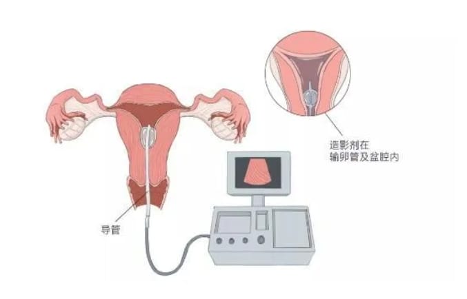输卵管积水的检查及治疗方法是什么？输卵管积水引起的不孕要直接做试管婴儿吗？