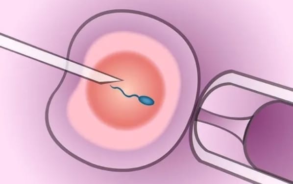 多囊卵巢综合征怎么治疗才能更快好孕？多囊卵巢综合征对女性生育和生活质量有何影响？
