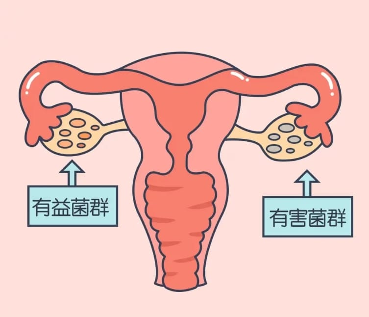 多囊卵巢综合征患者为何更容易得阴道炎？多囊卵巢综合征患者做试管婴儿注意事项有哪些？