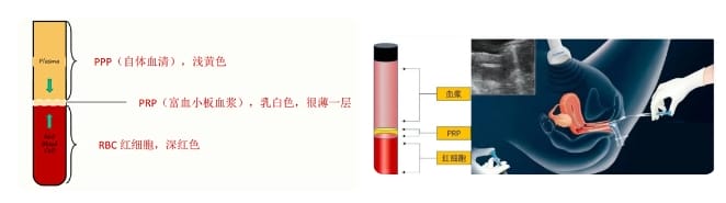 什么是PRP？PRP宫腔灌注治疗如何助力试管婴儿成功？PRP宫腔灌注适合哪类人群？