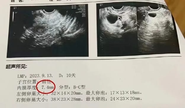 什么是PRP？PRP宫腔灌注治疗如何助力试管婴儿成功？PRP宫腔灌注适合哪类人群？