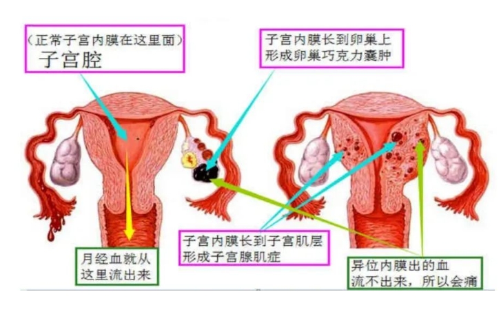 子宫内膜异位症到底会不会影响备孕? 子宫内膜异位症该如何治疗？